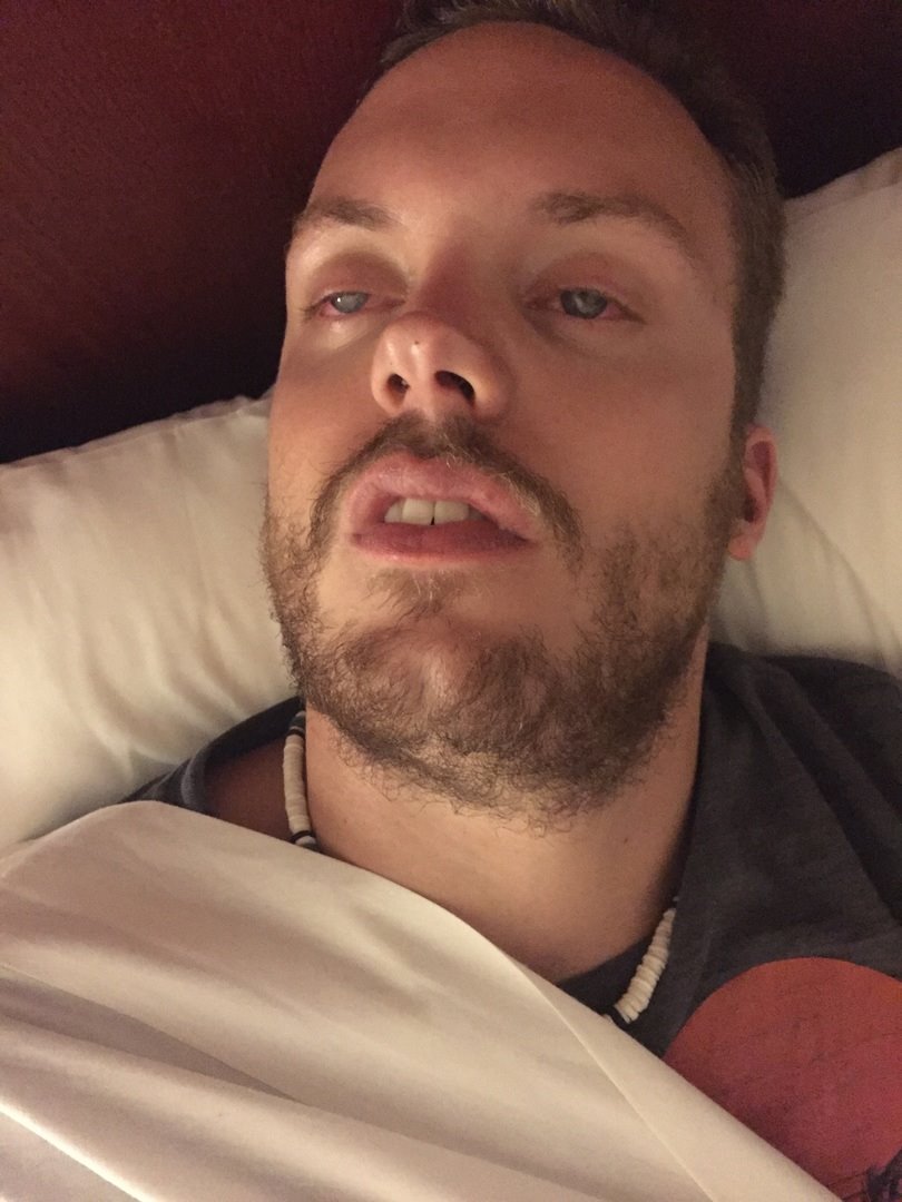 Photo showing eyes partially open during sleep (nocturnal lagophthalmos)