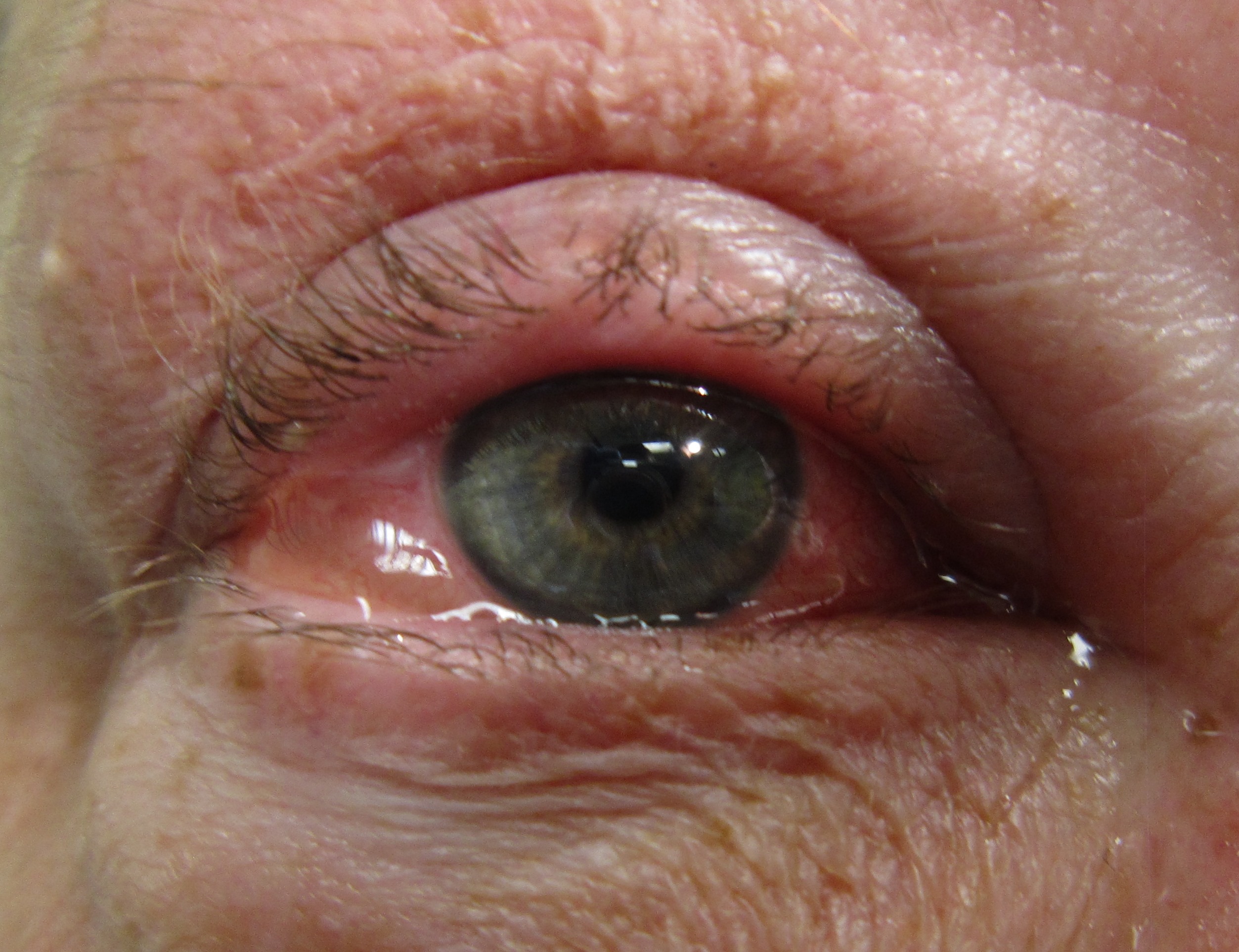 Close-up photo showing swollen, red conjunctiva typical of eye allergies