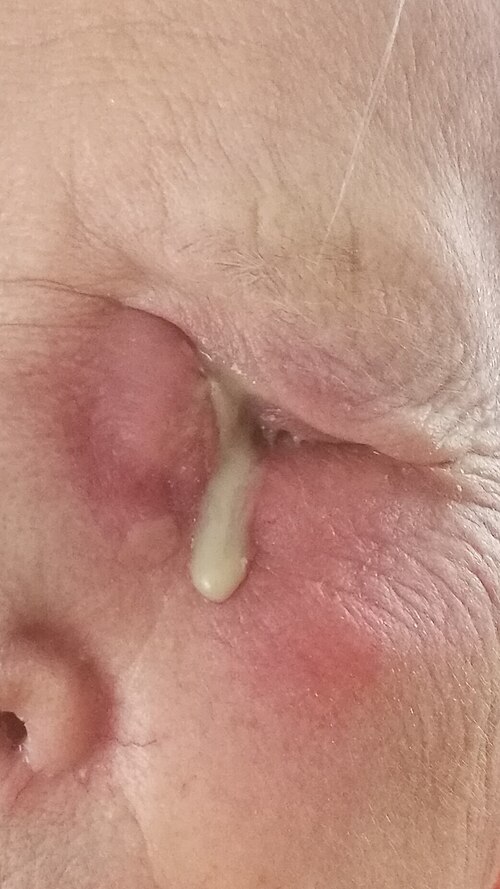 Photograph of pus draining at the inner corner of the eye from dacryocystitis