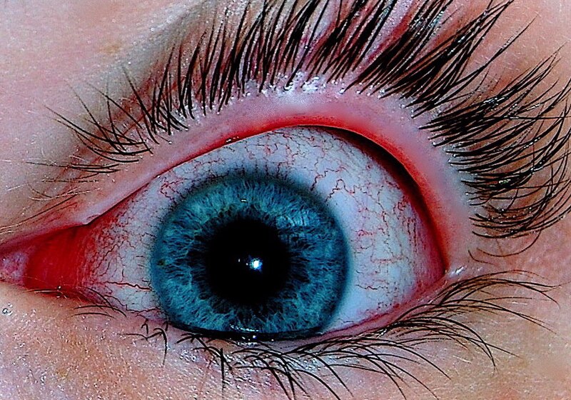 Red, watery eye consistent with viral conjunctivitis