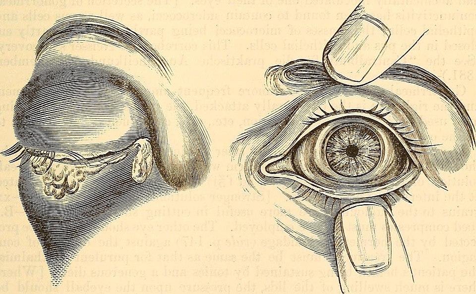 Historic medical illustration showing profuse purulent eye discharge