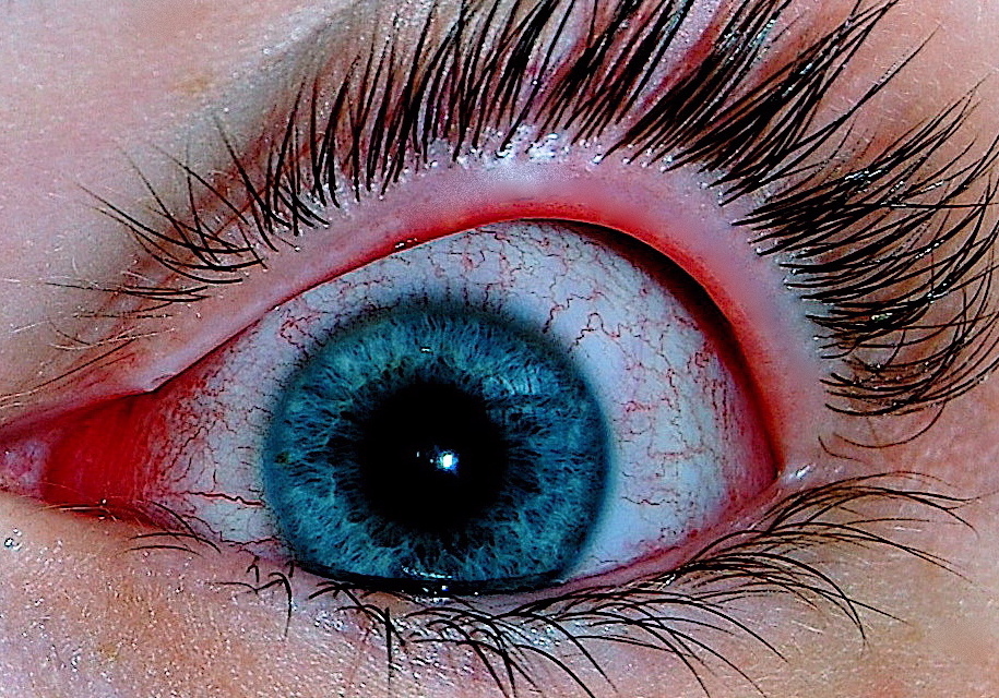 Close-up of an eye with viral conjunctivitis showing red, irritated conjunctival vessels.