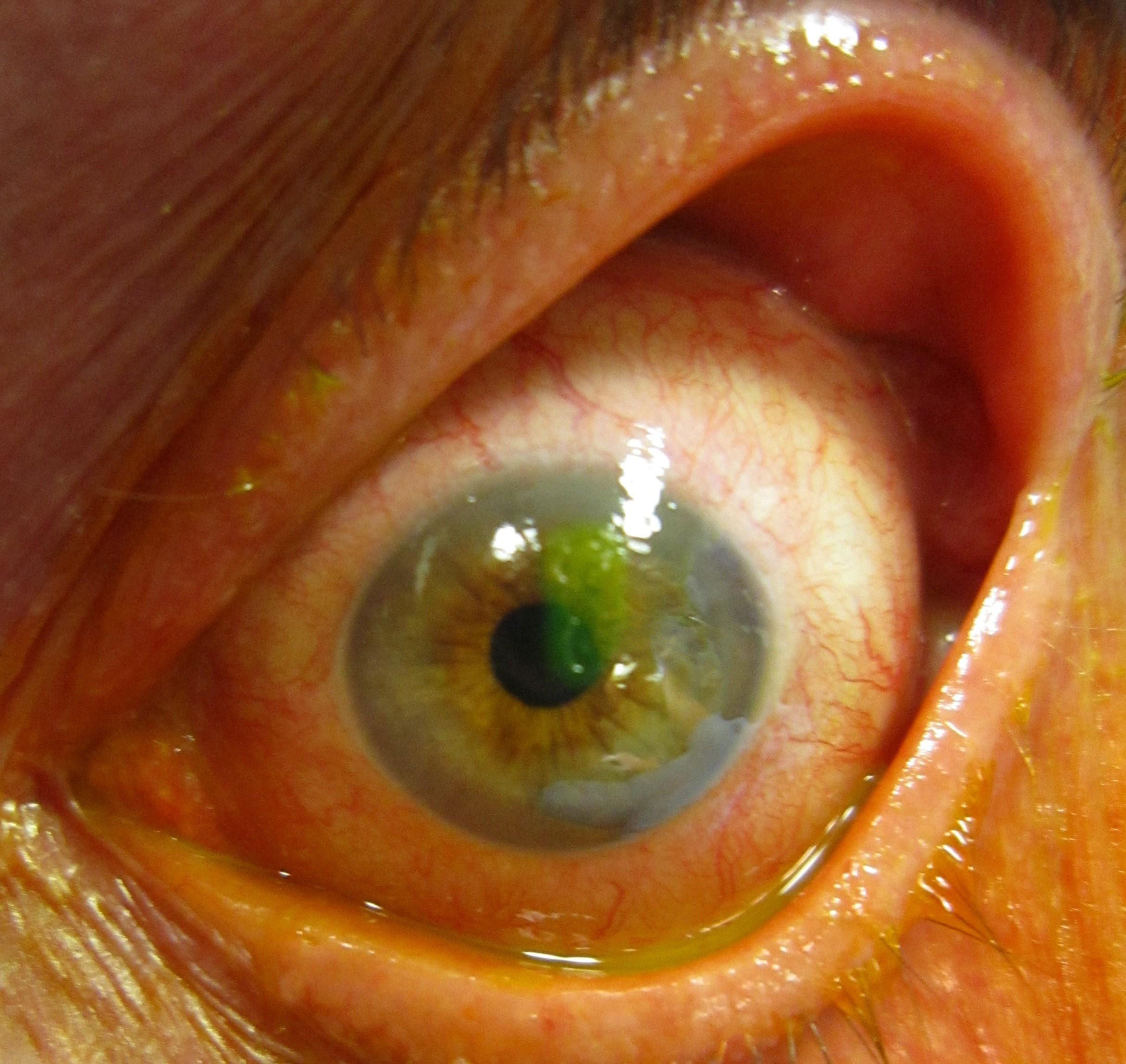 Fluorescein-stained corneal abrasion on the clear front surface of the eye.