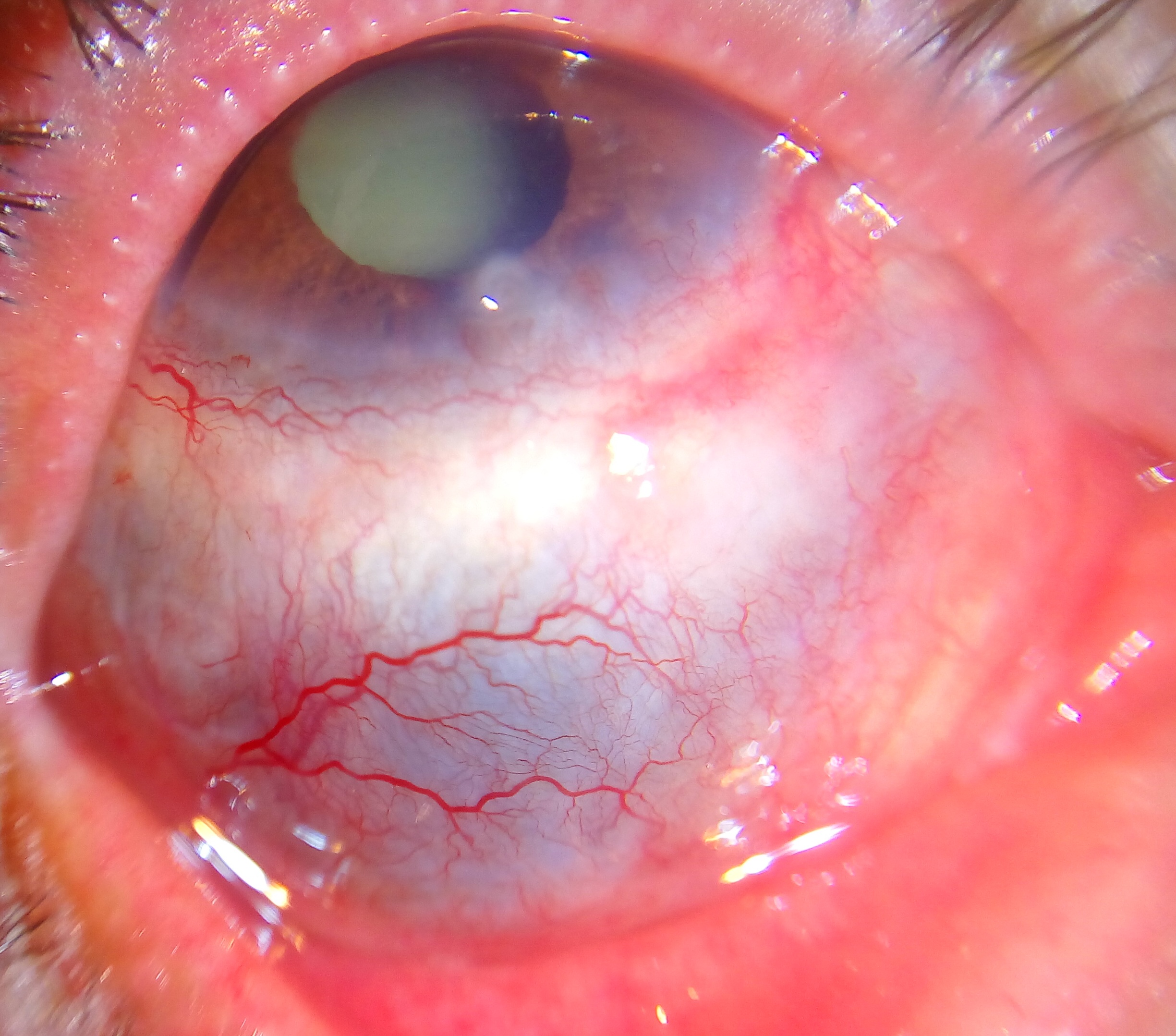 Close-up photo showing severe redness and scleral inflammation consistent with scleritis.