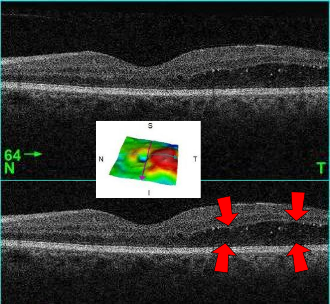 OCT image showing macular edema