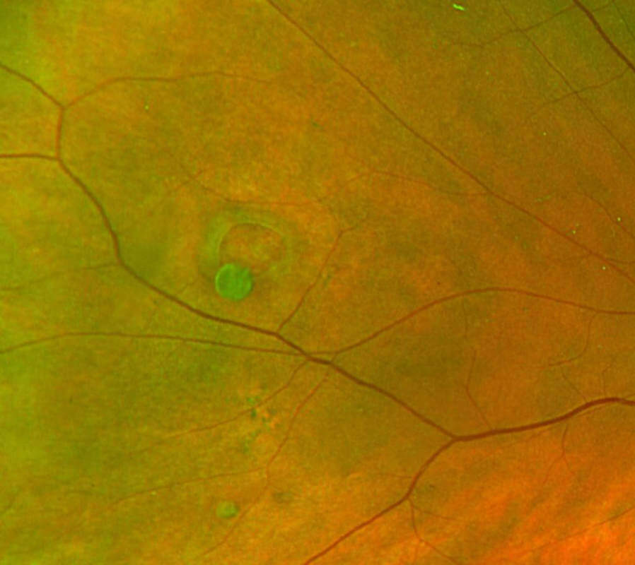 Color fundus photograph of a small round retinal hole.