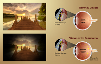 Illustration comparing normal and glaucoma vision