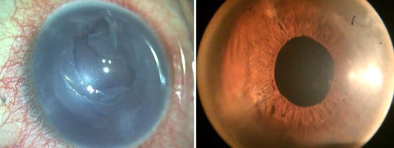 Side-by-side photos of a cornea before and after Pre-Descemet Endothelial Keratoplasty.
