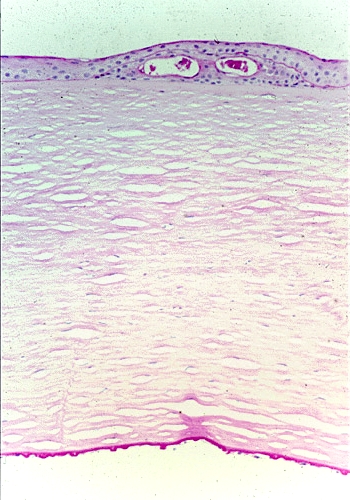 Light-microscopy slide showing excrescences (guttae) on Descemet’s membrane in Fuchs’ dystrophy.