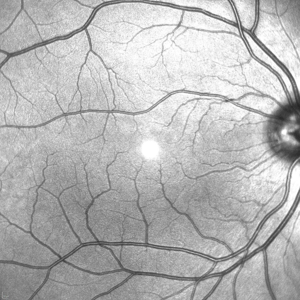 Infrared reflectance retinal image used during OCT-based eye exams