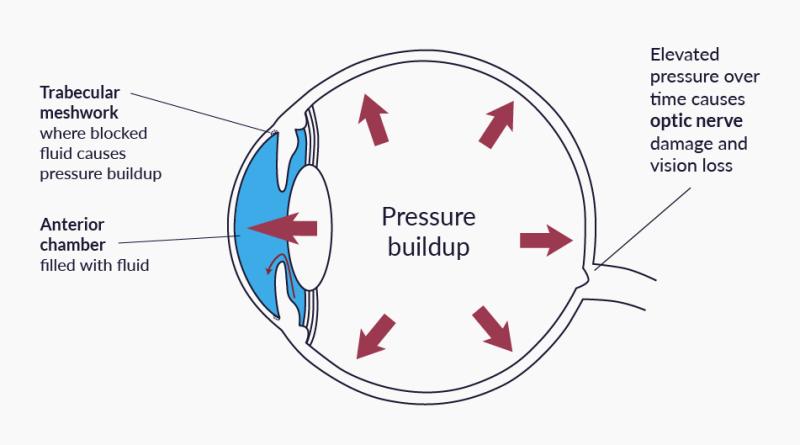 Illustration showing pressure buildup inside the eye in glaucoma