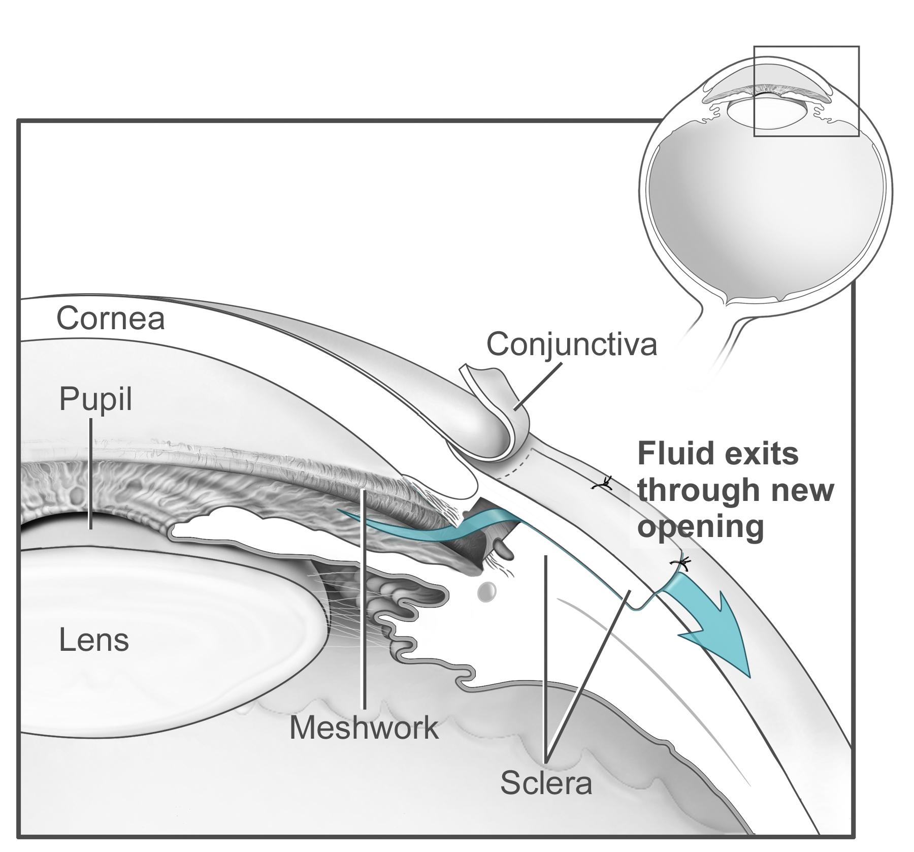 Trabeculectomy diagram demonstrating new drainage channel
