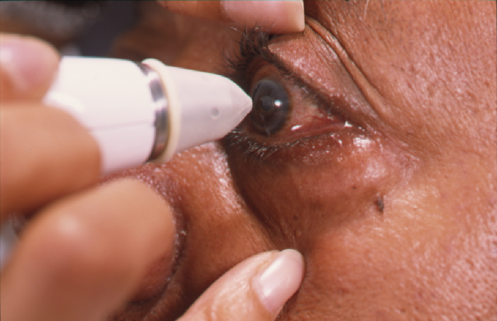 Man instilling glaucoma eye drops