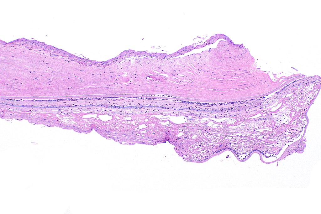 Low-magnification histology of cornea with herpes stromal keratitis changes