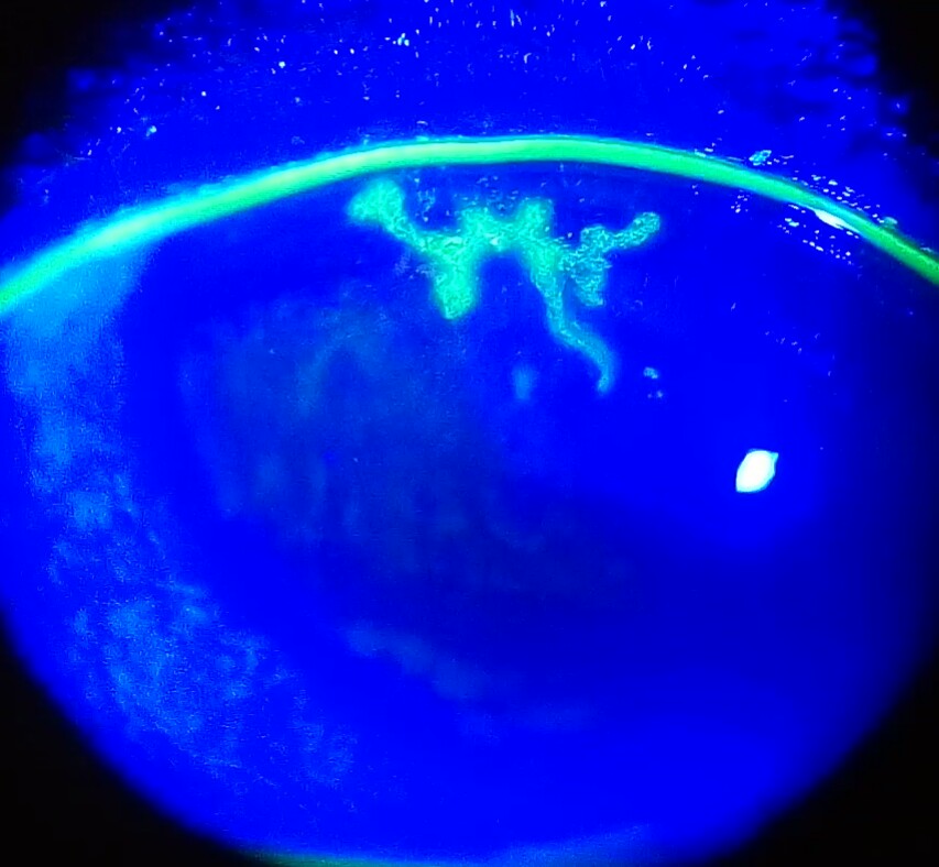 Fluorescein-stained cornea showing a dendritic ulcer typical of herpes simplex epithelial keratitis
