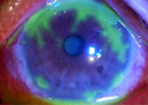 Fluorescein-stained cornea with a broad geographic epithelial defect from HSV