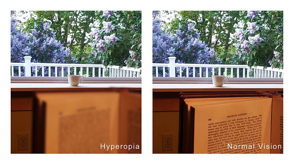 Side-by-side comparison photo showing blurred near vision in hyperopia versus sharp near vision in normal sight.