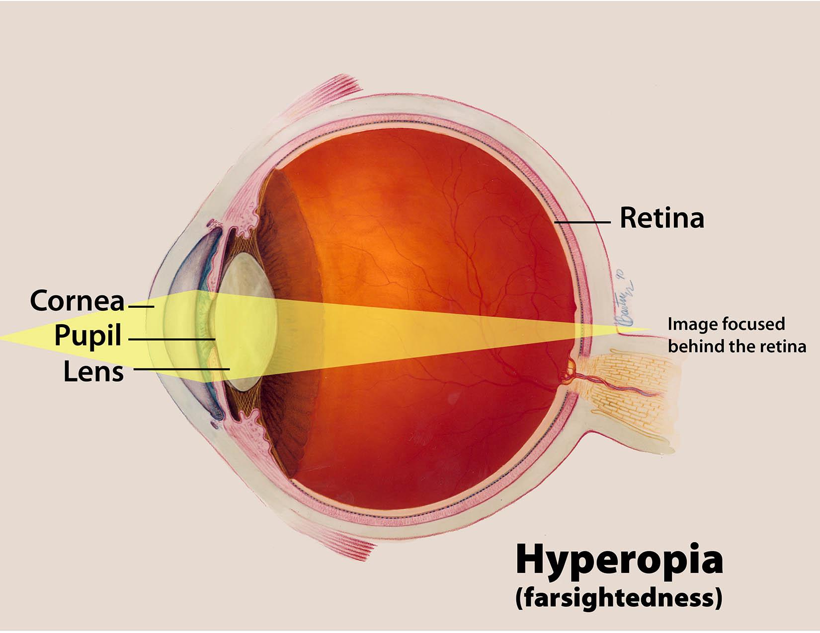 Diagram showing how, in hyperopia, incoming light focuses behind the retina (English labels).