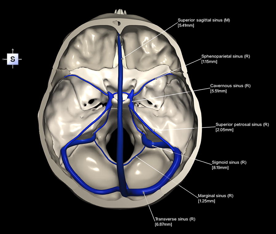 Labeled anatomy of the dural venous sinuses including transverse sinuses