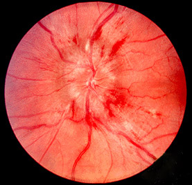 Fundus photograph showing papilledema with blurred optic disc margins