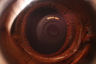 Slit-lamp view of an intraocular lens years after surgery