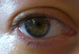 Eye 24 hours after phakic ICL implantation