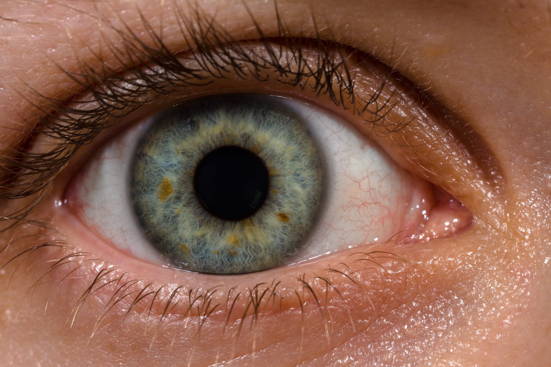 Close-up photo of a human eye with visible surface blood vessels