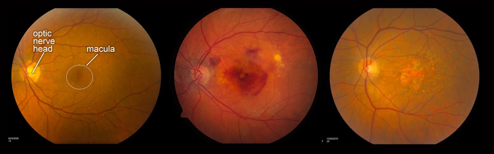 Fundus images: normal vs wet AMD vs dry AMD