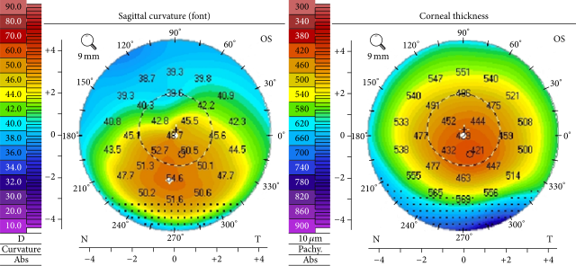 Color corneal topography map showing steep inferior cone in keratoconus.