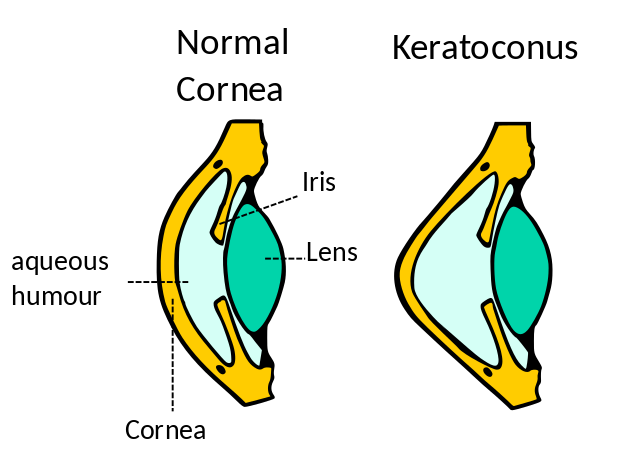 Diagram comparing a healthy cornea with the cone-shaped cornea seen in keratoconus.