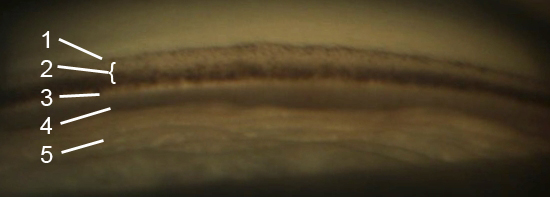 Gonioscopy view of the anterior chamber angle with labeled structures