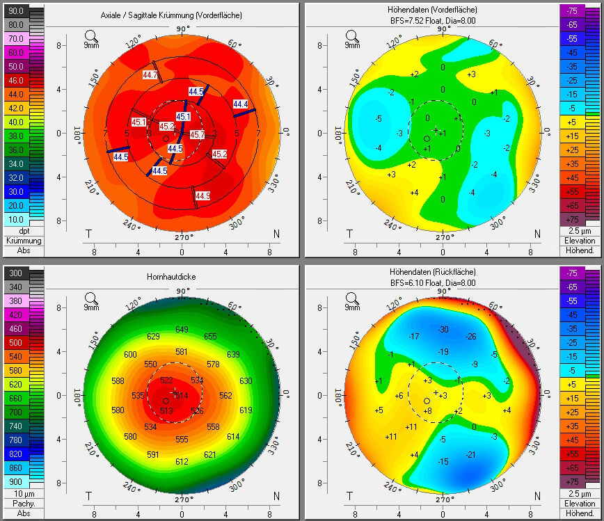 Four-panel corneal topography map captured before LASIK surgery