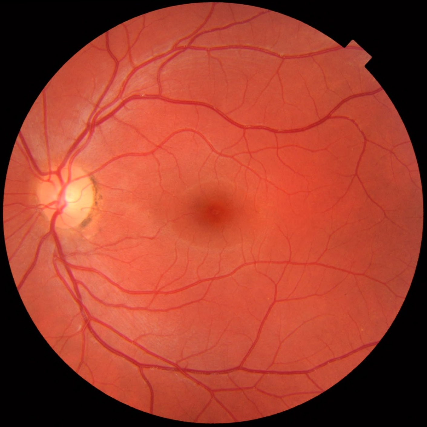 Color fundus photograph of a normal human retina for comparison