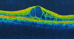 Colorized OCT image of cystoid spaces forming in cystoid macular edema.