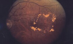 Fundus photograph showing diabetic macular edema with yellow lipid exudates near the macula.