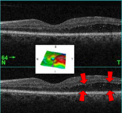 Optical coherence tomography (OCT) cross‑section highlighting areas of macular swelling.
