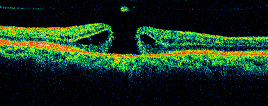 OCT scan displaying a large full‑thickness macular hole with classic ‘anvil‑shaped’ edges.