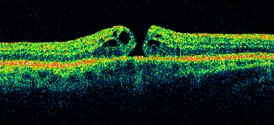 High‑resolution OCT of a small macular hole with intraretinal cysts.