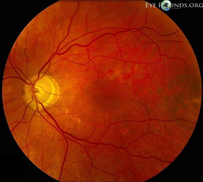 Fundus photograph showing a full‑thickness macular hole with surrounding retinal changes.