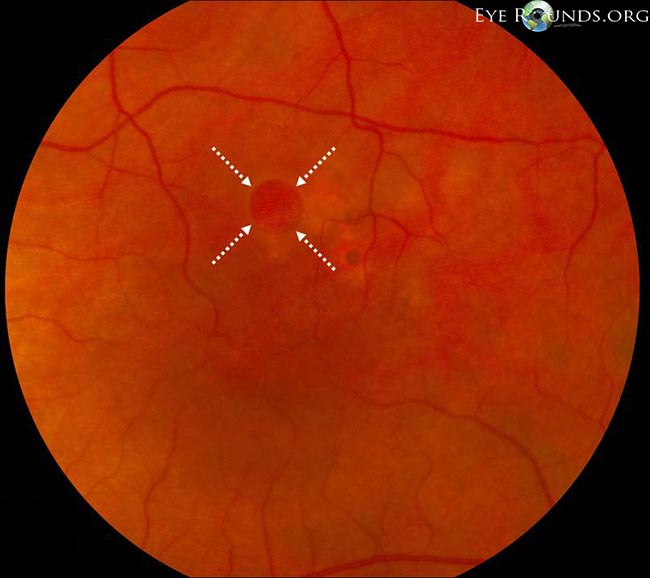 Magnified fundus photograph with dashed arrows marking the macular hole opening.
