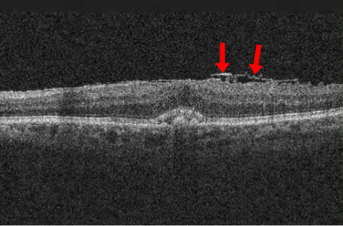 Optical coherence tomography scan with red arrows pointing to an epiretinal membrane on the macula.