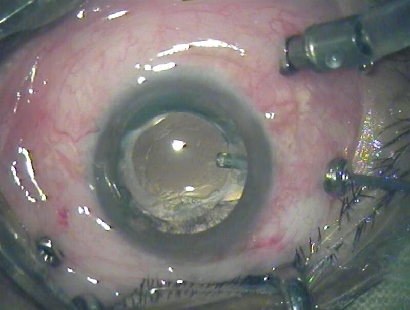 Surgical setup showing a three-port 23-gauge vitrectomy system used for membrane peeling.