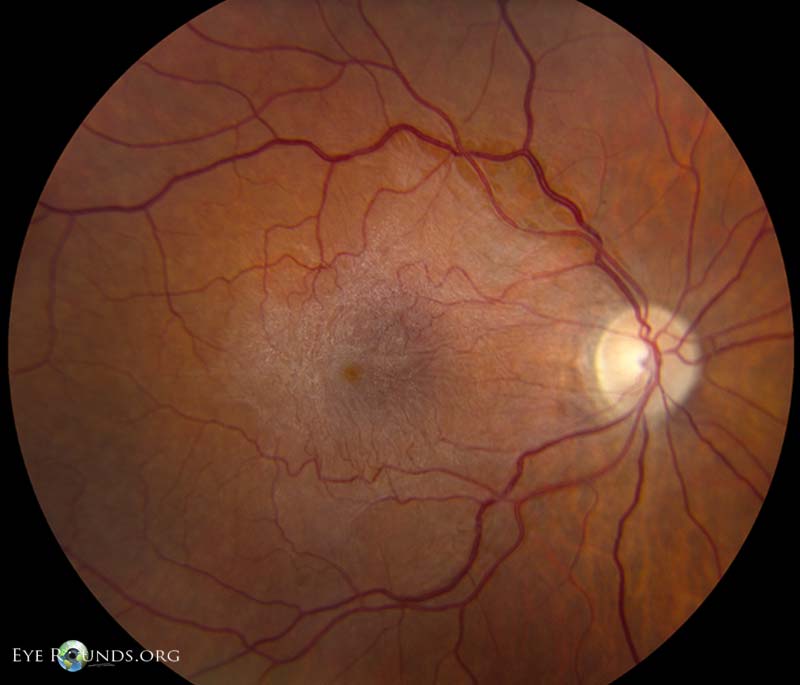 Color fundus photograph showing a shiny, wrinkled epiretinal membrane over the macula.