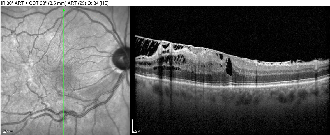 Infra-red fundus image with corresponding OCT cross-section demonstrating retinal distortion beneath an epiretinal membrane.