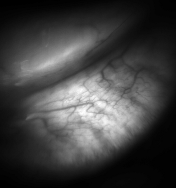 Infrared meibography image of meibomian glands highlighting their tree-branch architecture.