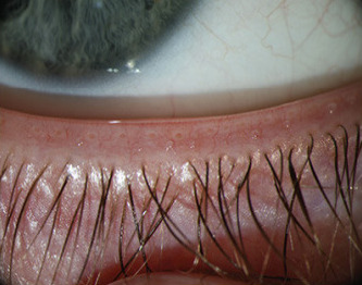 Close-up photograph of the lower eyelid showing multiple meibomian gland orifices along the margin.