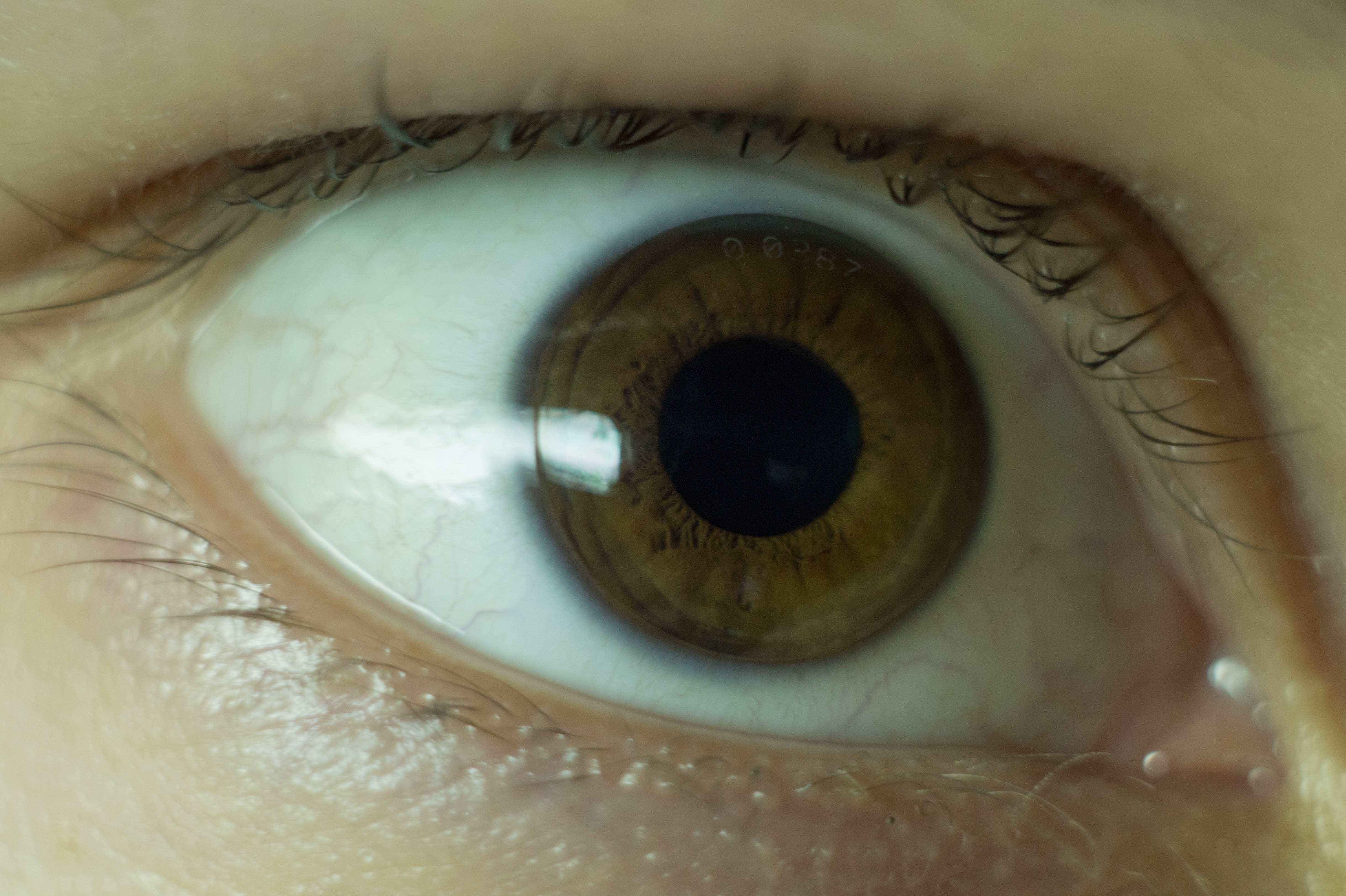 Orthokeratology lens on the eye