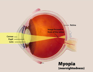 Diagram showing how light focuses in a myopic eye