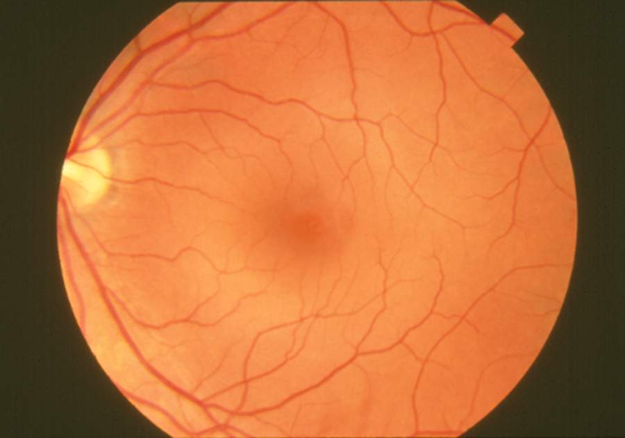 Color fundus photograph of a normal retina with clear optic disc and vessels