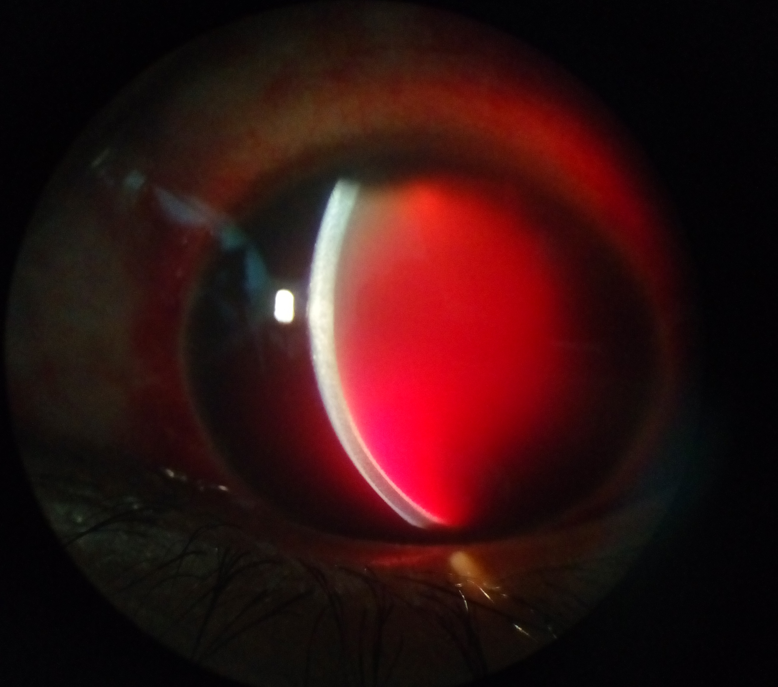 Slit-lamp photo showing total hyphema with blood filling the anterior chamber